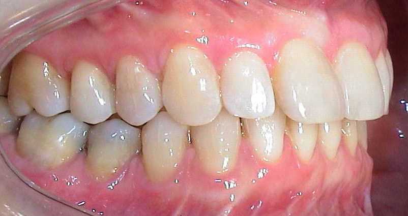 Erfolgreicher Korrektur Zahnfehlstellung und Kinnoperation